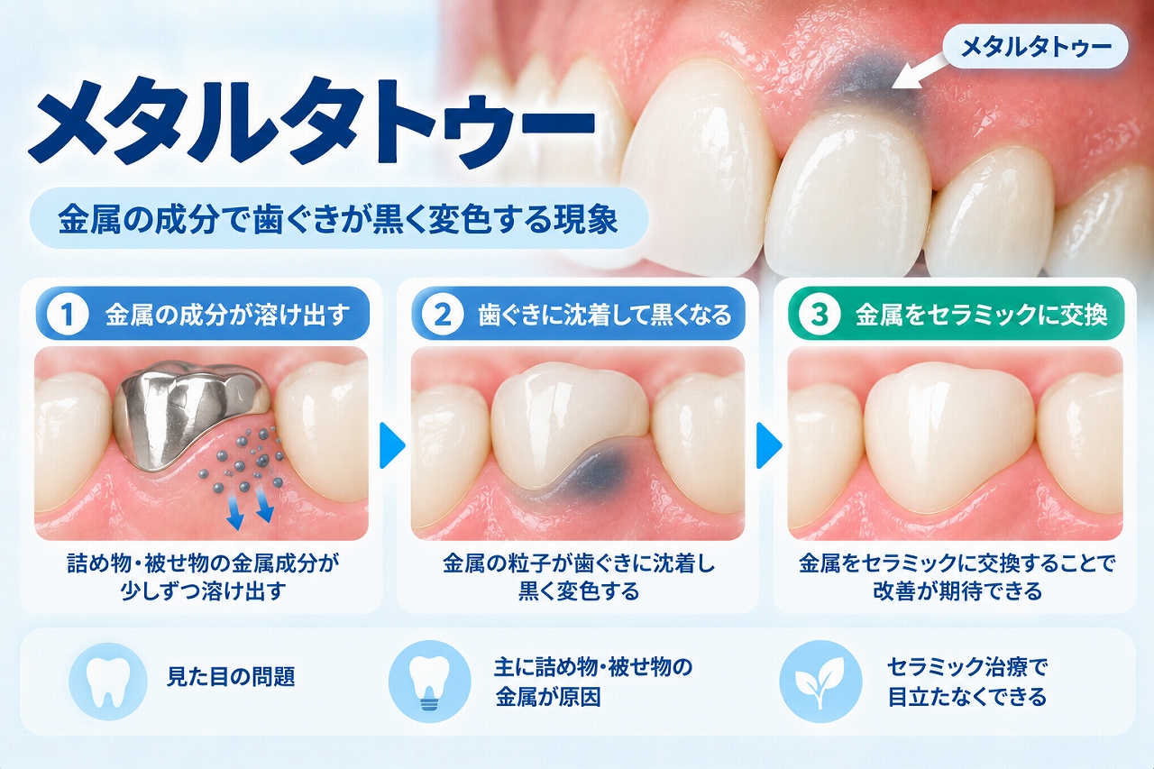 メタルタトゥーについて、詰め物や被せ物などの金属に由来する成分によって歯ぐきが黒く変色する状態を示した図