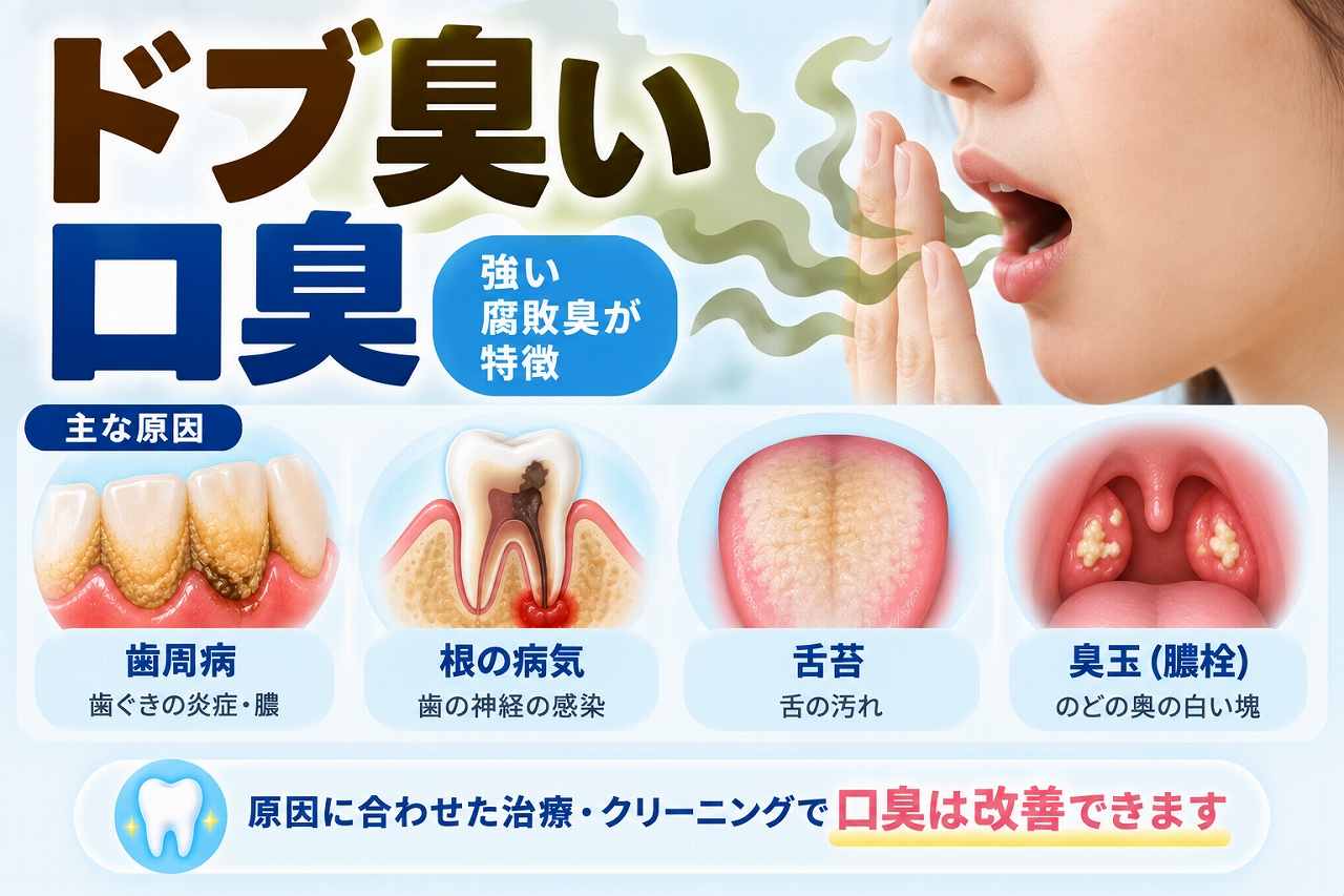 ドブ臭いと感じる強い口臭について、歯周病や歯の根の病気、舌苔、臭玉（膿栓）などの主な原因を示した図