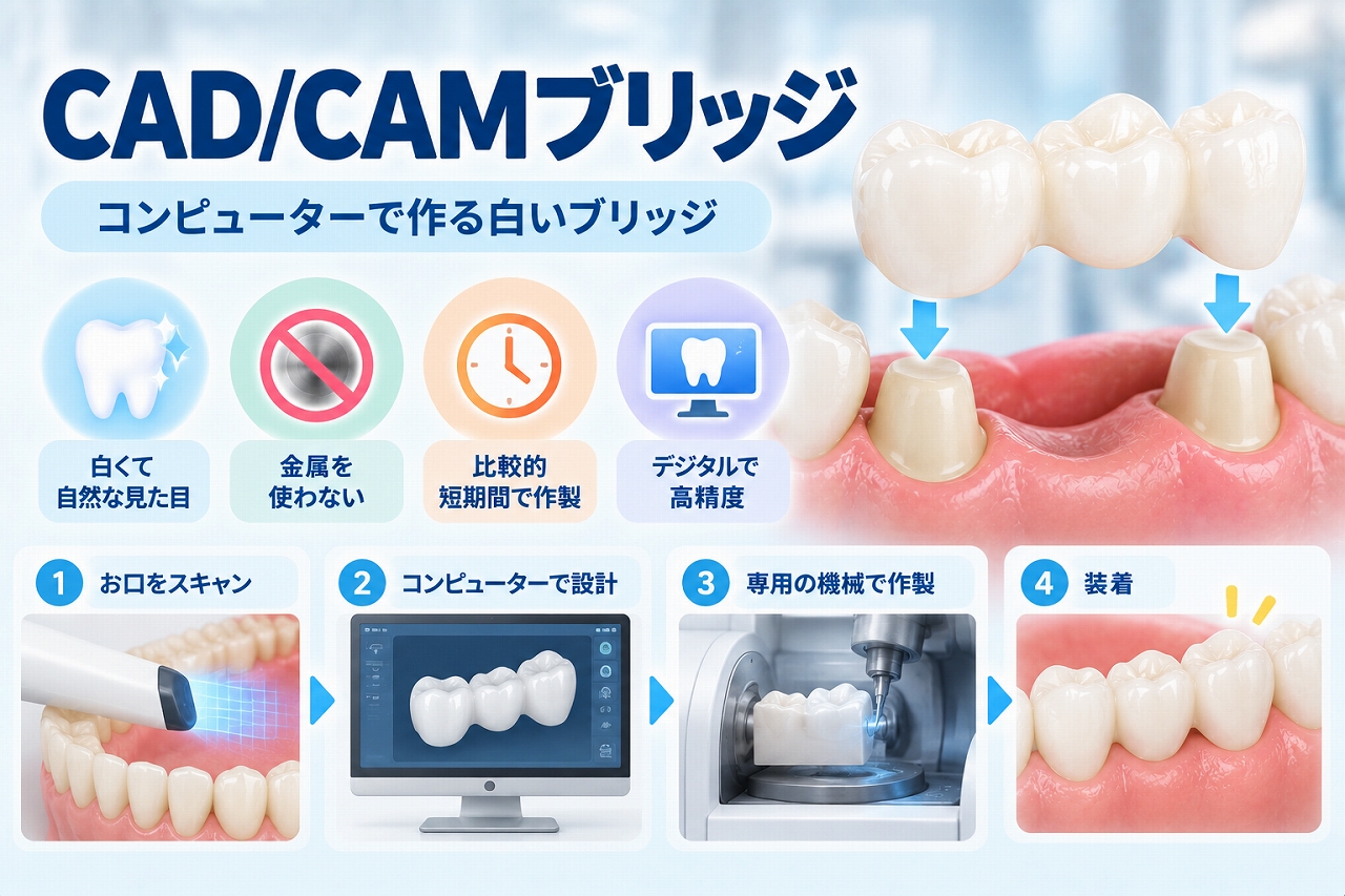 CAD/CAMブリッジについて、口腔内スキャンからコンピューターによる設計、専用機器での作製、白いブリッジの装着までの流れを示した図