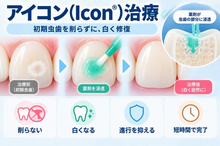 アイコン（Icon®）治療について、初期虫歯やホワイトスポットに薬剤を浸透させ、歯を削らずに白い斑点の見た目を改善する治療の仕組みを示した図