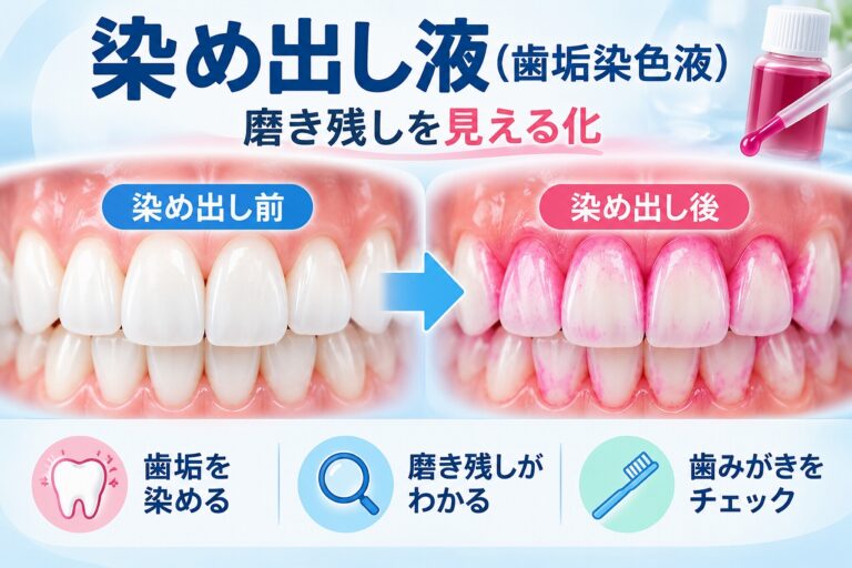染め出し液（歯垢染色液）を使用する前後の歯を比較し、歯垢や磨き残しが赤やピンク色に染まって見える仕組みを示した図