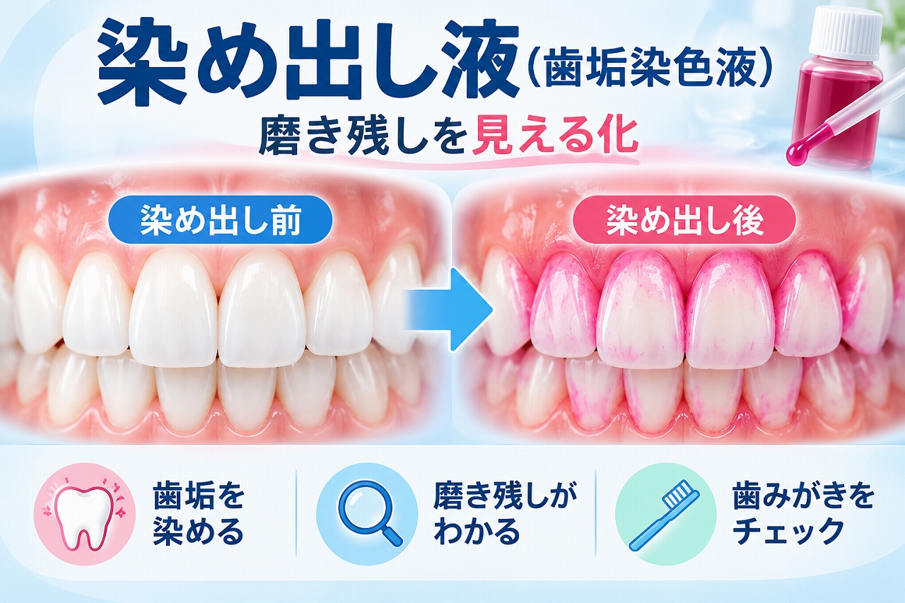 染め出し液（歯垢染色液）を使用する前後の歯を比較し、歯垢や磨き残しが赤やピンク色に染まって見える仕組みを示した図
