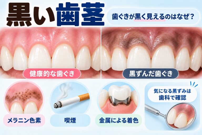 黒い歯茎の原因は？｜メラニン色素・喫煙・金属による着色
