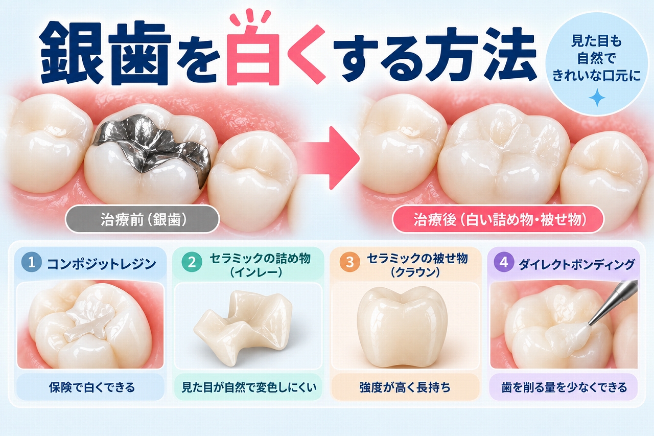 銀歯を白くする方法について、銀歯から白い歯への治療前後と、コンポジットレジンやセラミックの詰め物・被せ物などの治療方法を示した図