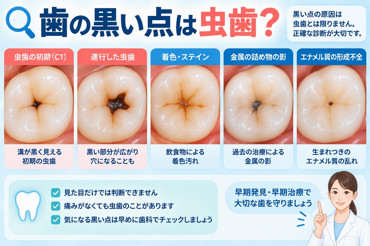 歯の黒い点について、虫歯・着色・金属の詰め物の影・エナメル質形成不全などの原因を比較した図