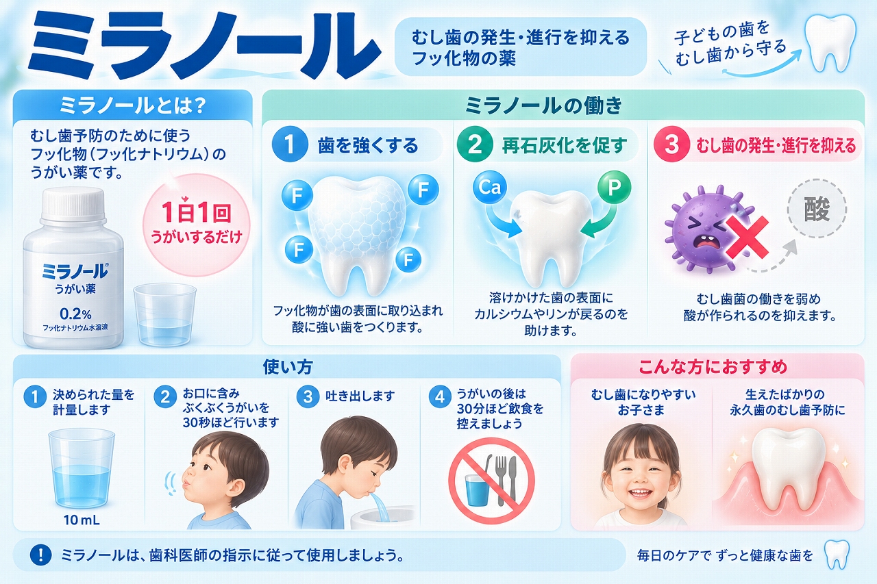 ミラノールによるフッ化物洗口について、歯質強化・再石灰化・虫歯菌の酸産生を抑える働きと、洗口方法を示した図