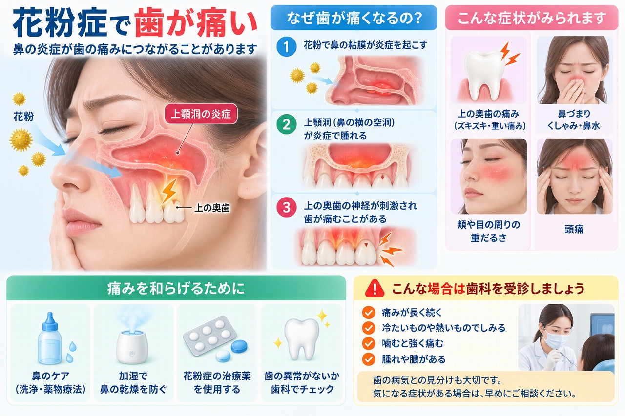 花粉症による鼻や上顎洞の炎症と、上の奥歯に痛みを感じる仕組みを示した図