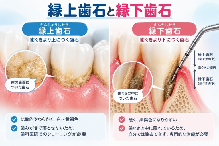 縁上歯石と縁下歯石の違い