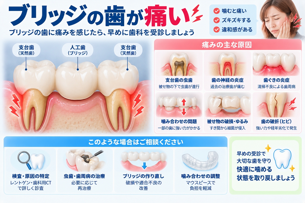ブリッジの歯が痛い原因となる支台歯の虫歯・歯髄炎・歯周病・噛み合わせ・歯のヒビなどを示した図