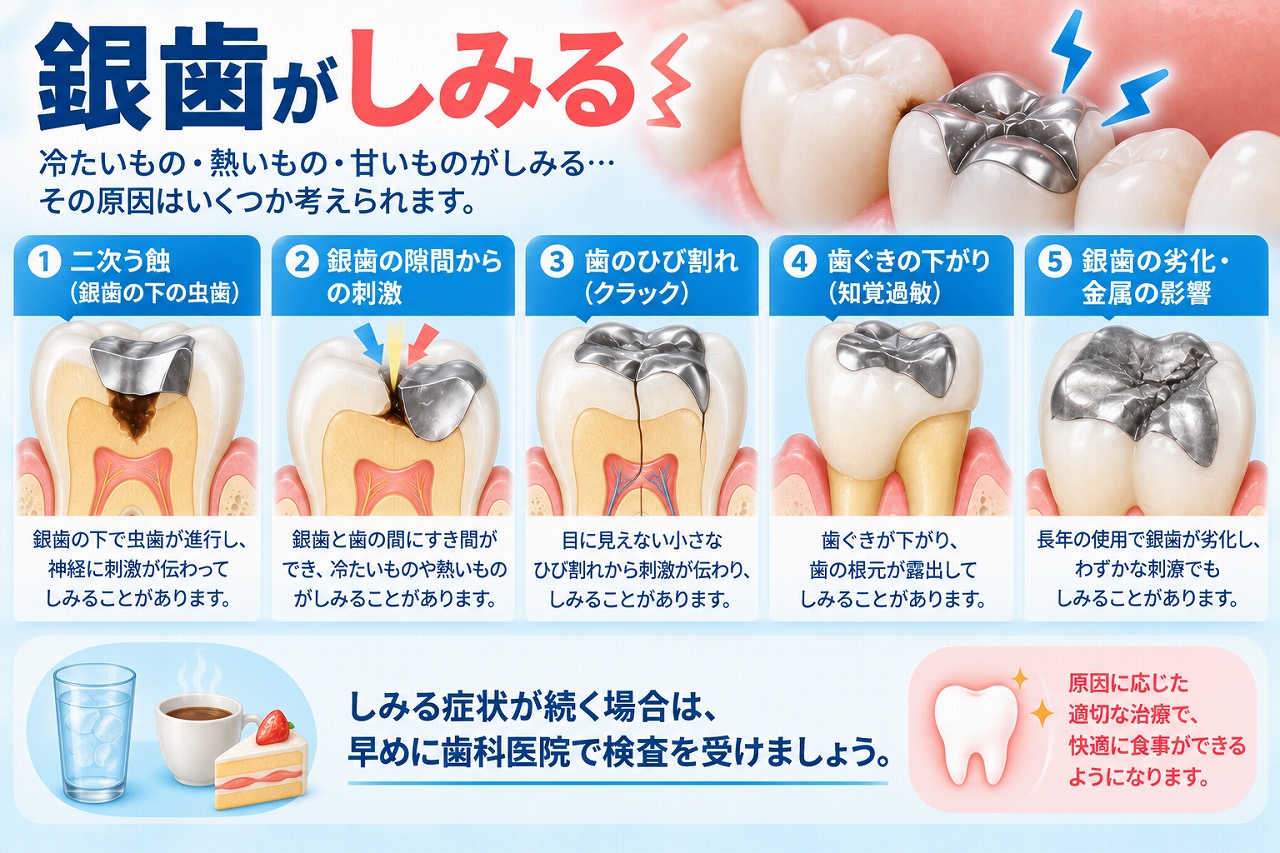 銀歯がしみる原因として、銀歯の下の虫歯、銀歯との隙間、歯のひび割れ、歯ぐきの後退、銀歯の劣化を示した図