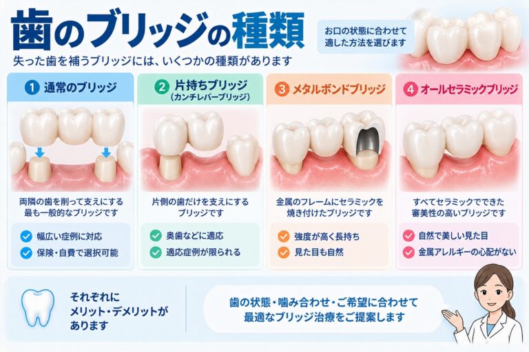 歯のブリッジの種類とは？形や素材による違いを解説