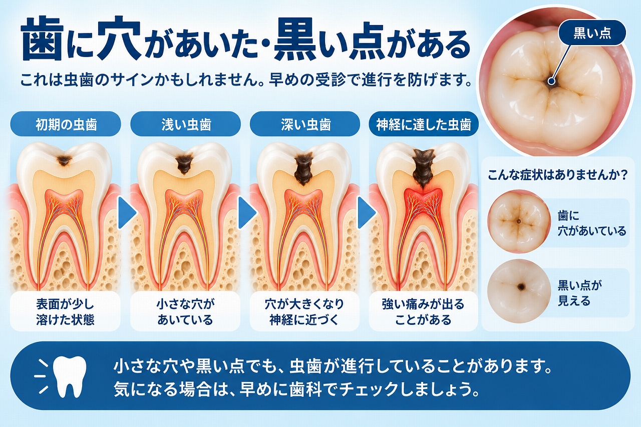 歯に小さな穴や黒い点が現れ、虫歯がエナメル質から象牙質、歯の神経へ進行する様子を示した図