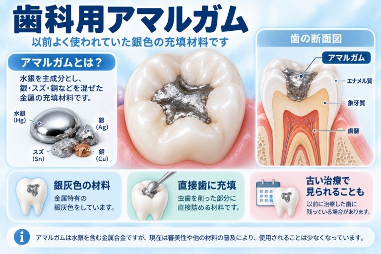 歯科用アマルガムとは｜以前使われていた銀色の歯科用充填材料