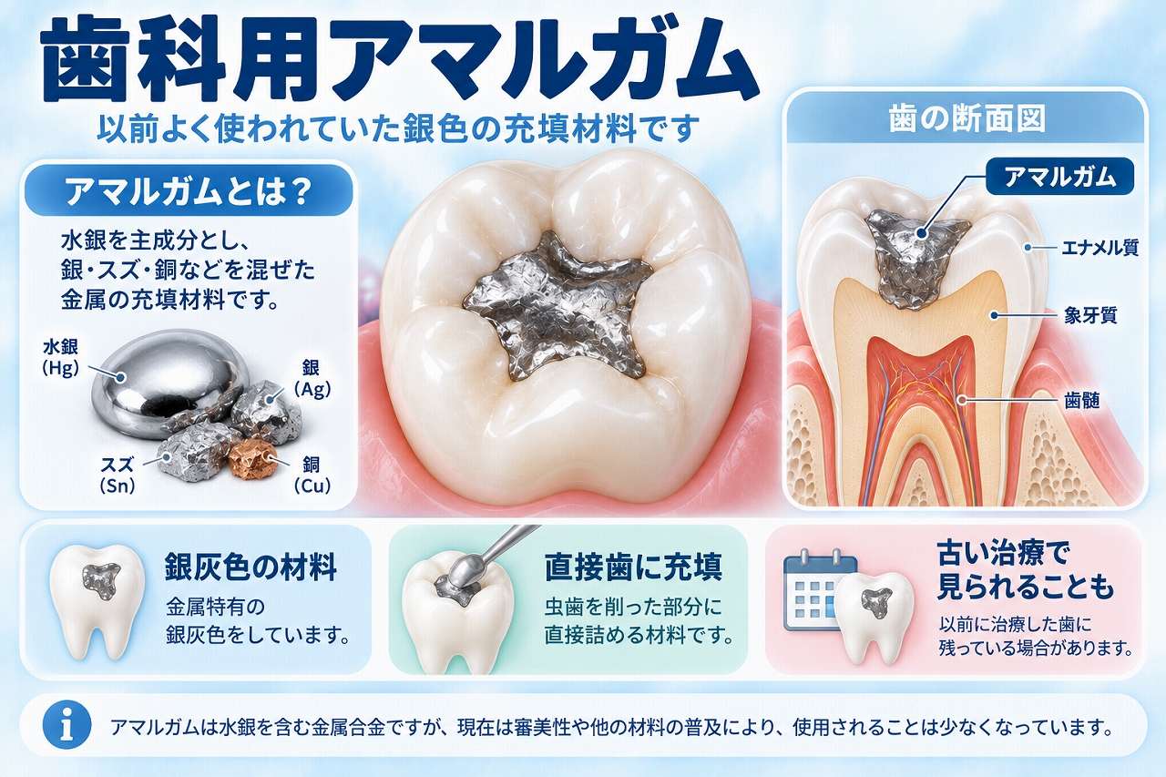 歯科用アマルガムについて、水銀などを含む銀灰色の金属合金を虫歯を削った部分に直接充填した状態と歯の断面を示した図