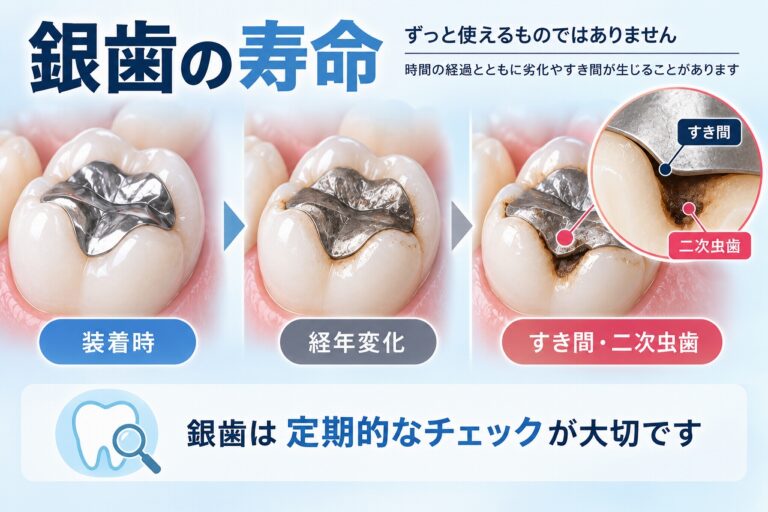 銀歯の寿命はどのくらい？劣化と二次虫歯に注意