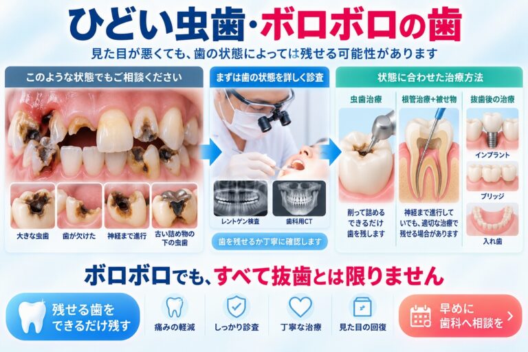 ひどい虫歯・ボロボロの歯｜重度の虫歯でも歯を残せる可能性