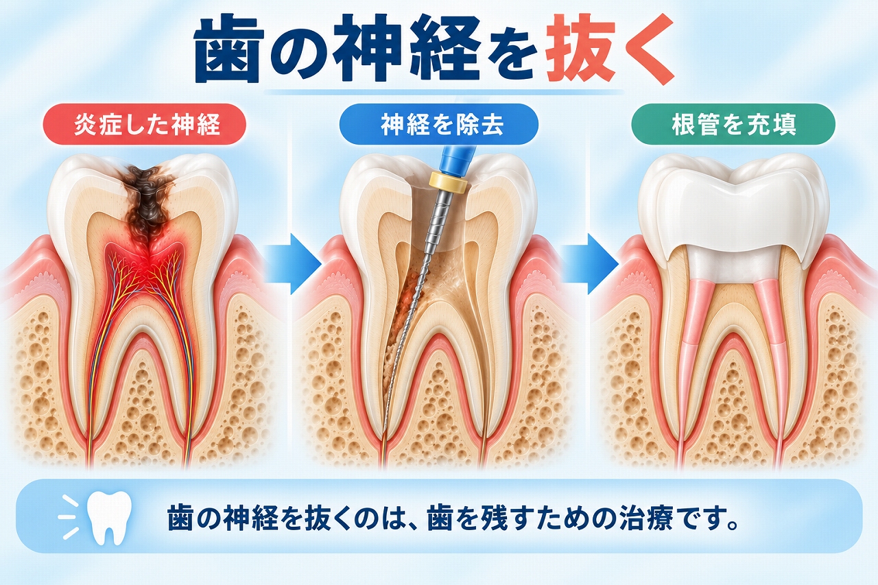 炎症した歯の神経を取り除き、根管内を充填して歯を残す治療の流れを示した図
