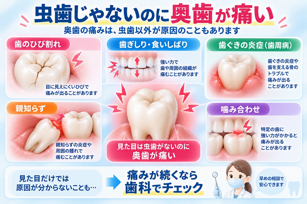 虫歯が見当たらないのに奥歯が痛む原因として、歯のひび割れ、歯ぎしり・食いしばり、歯ぐきの炎症、親知らず、噛み合わせを示した図