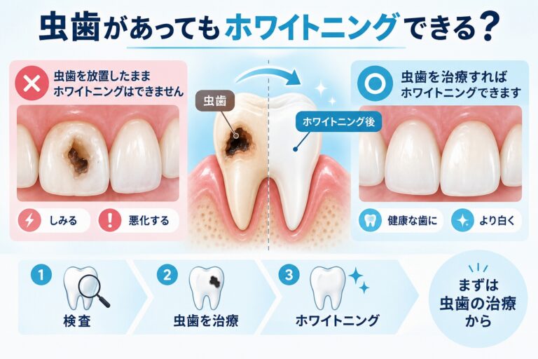 虫歯があってもホワイトニングできる？｜治療の順番を解説