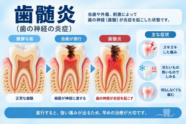 歯髄炎とは｜虫歯が神経まで進行して炎症を起こした状態