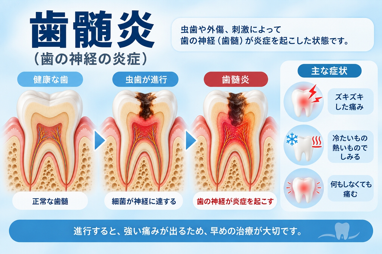 虫歯が歯髄まで進行して歯の神経に炎症が起こる歯髄炎と、痛みや冷温刺激による症状を示した図