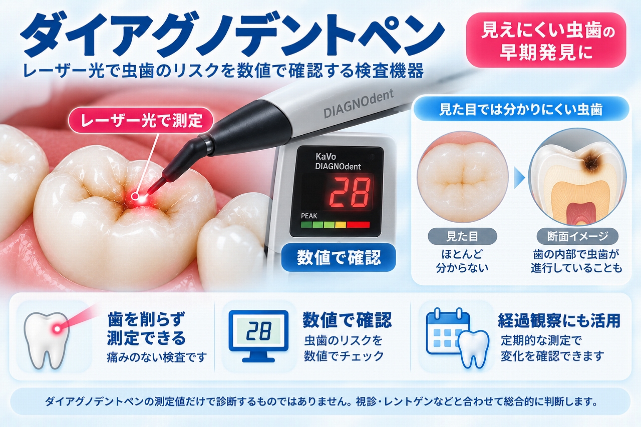 ダイアグノデントペンのレーザー光を奥歯の溝に当て、目では分かりにくい虫歯の状態を数値で測定する様子を示した図