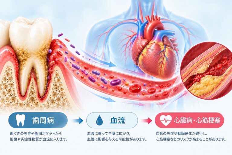 歯周病と心臓病・心筋梗塞の関係を示すイラスト