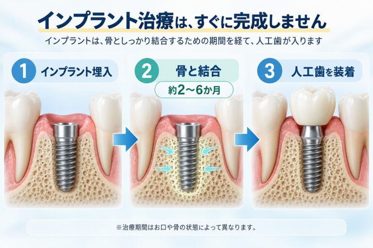 インプラント治療期間｜埋入から人工歯装着まで