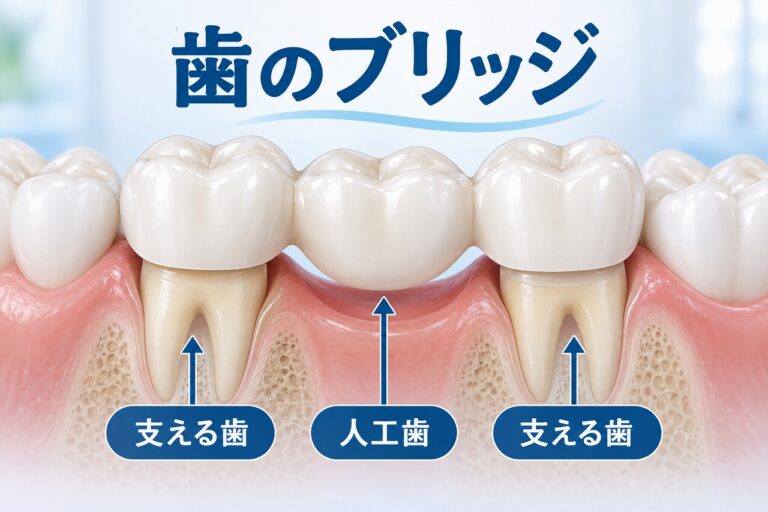 歯のブリッジ｜失った歯を両隣の歯で支える治療