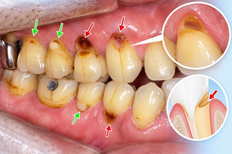 楔状欠損｜歯の根元がくさび状に削れる症状