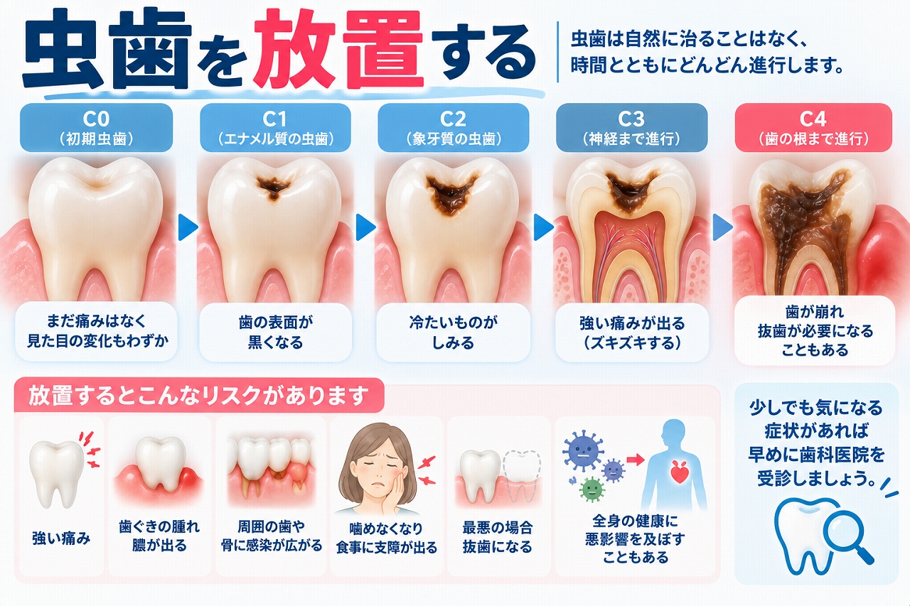 虫歯を放置した場合のC0からC4までの進行と、痛み・歯茎の腫れ・抜歯などのリスクを示した図