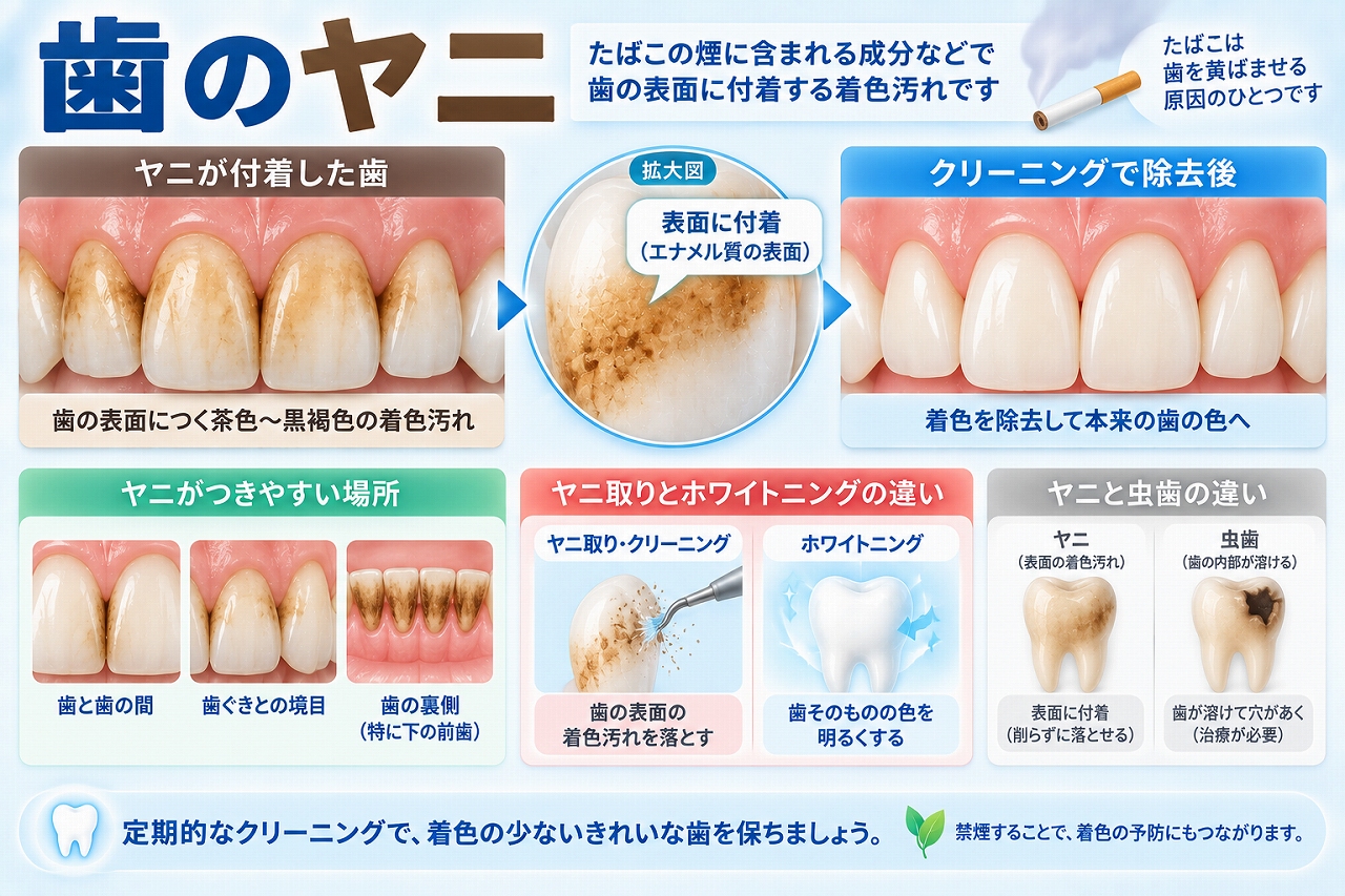 たばこによるヤニが歯の表面や歯と歯の間、歯ぐきとの境目に茶色〜黒褐色の着色として付着する様子と、歯科クリーニングによる除去を示した図