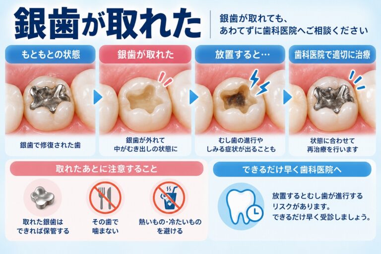 銀歯が取れたらどうする？外れたときの対処法と注意点