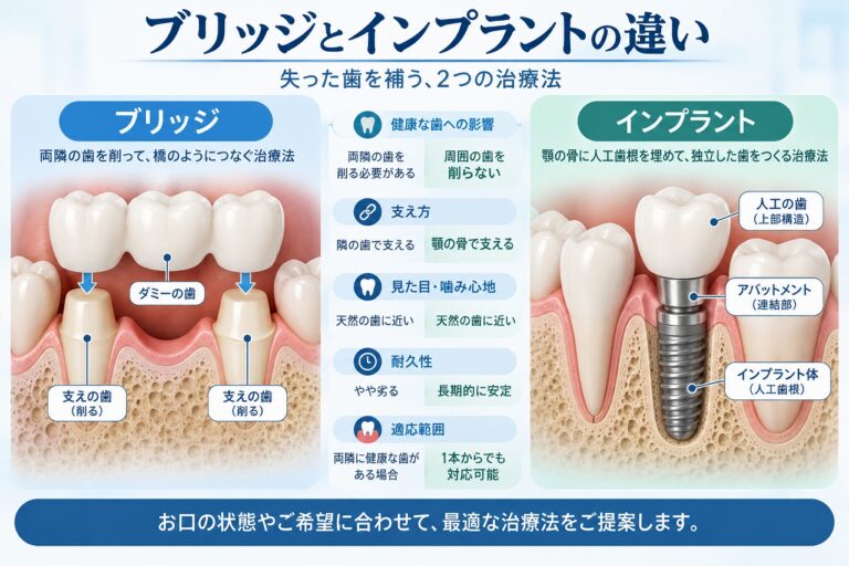 ブリッジとインプラントの違い｜失った歯を補う治療法を比較