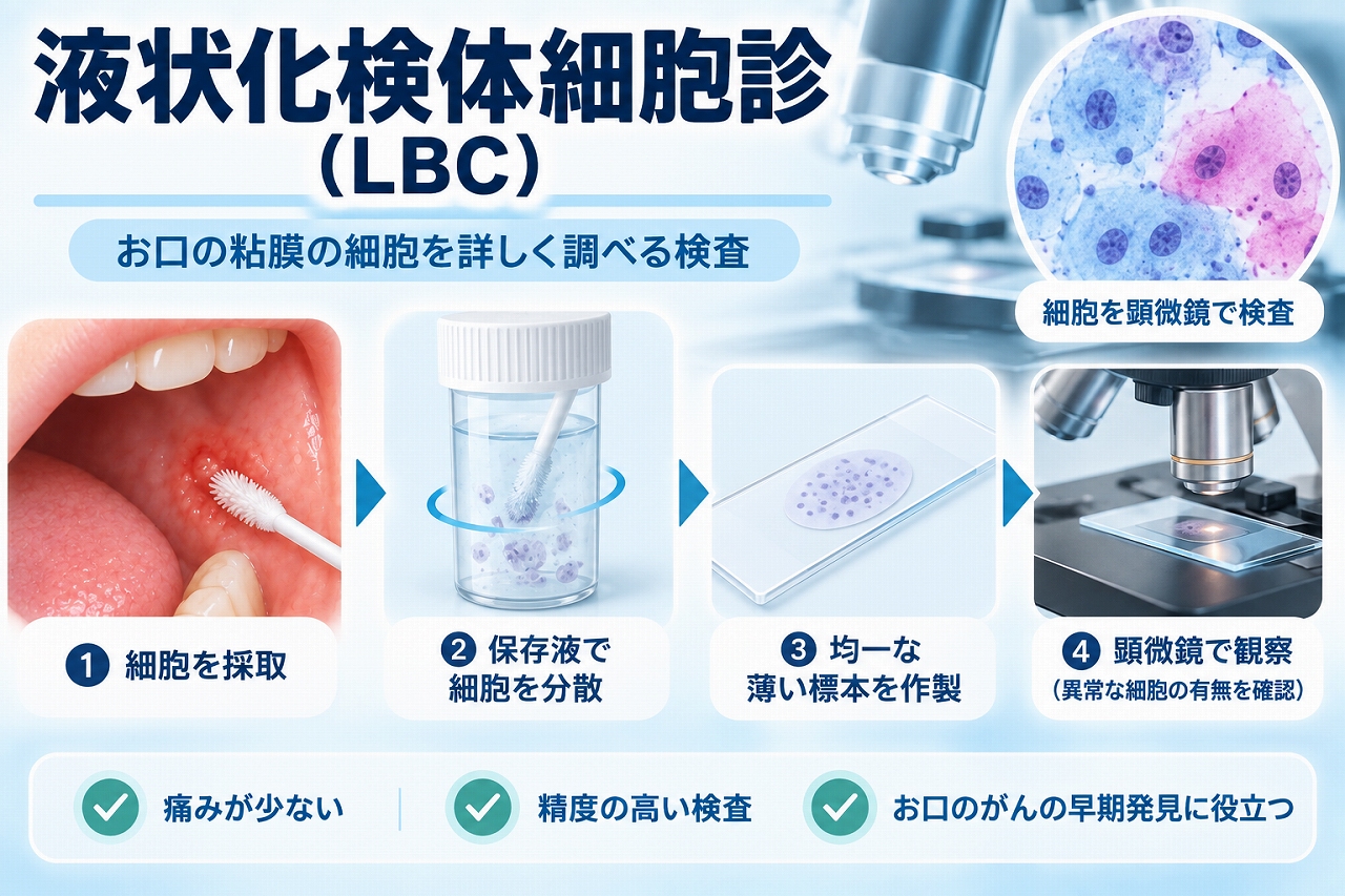 液状化検体細胞診（LBC）で口腔粘膜から細胞を採取し、保存液で処理して標本を作製し、顕微鏡で観察する流れを示したイラスト
