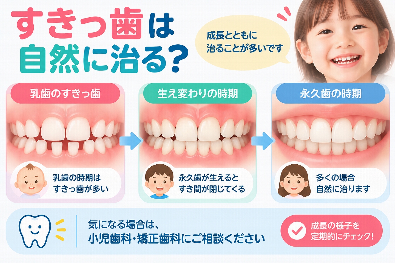 子どものすきっ歯について、乳歯期から永久歯への生え変わりに伴って歯のすき間が変化し、自然に改善する場合があることを示した歯科イラスト