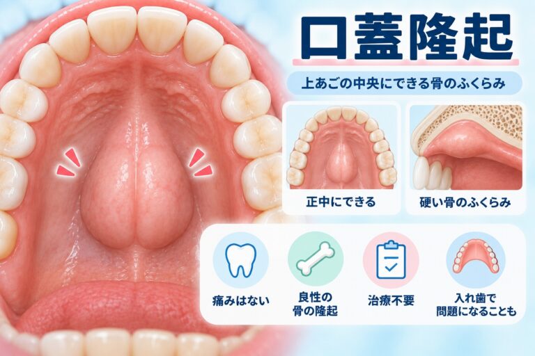 口蓋隆起によって上あごの中央に硬い骨のふくらみができた状態と、入れ歯への影響を示した歯科イラスト