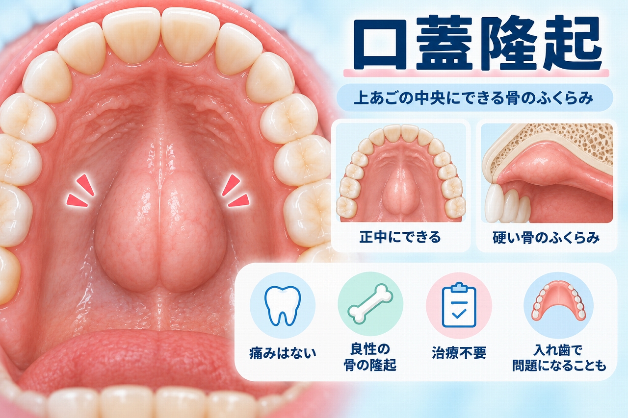 口蓋隆起によって上あごの中央に硬い骨のふくらみができた状態と、入れ歯への影響を示した歯科イラスト