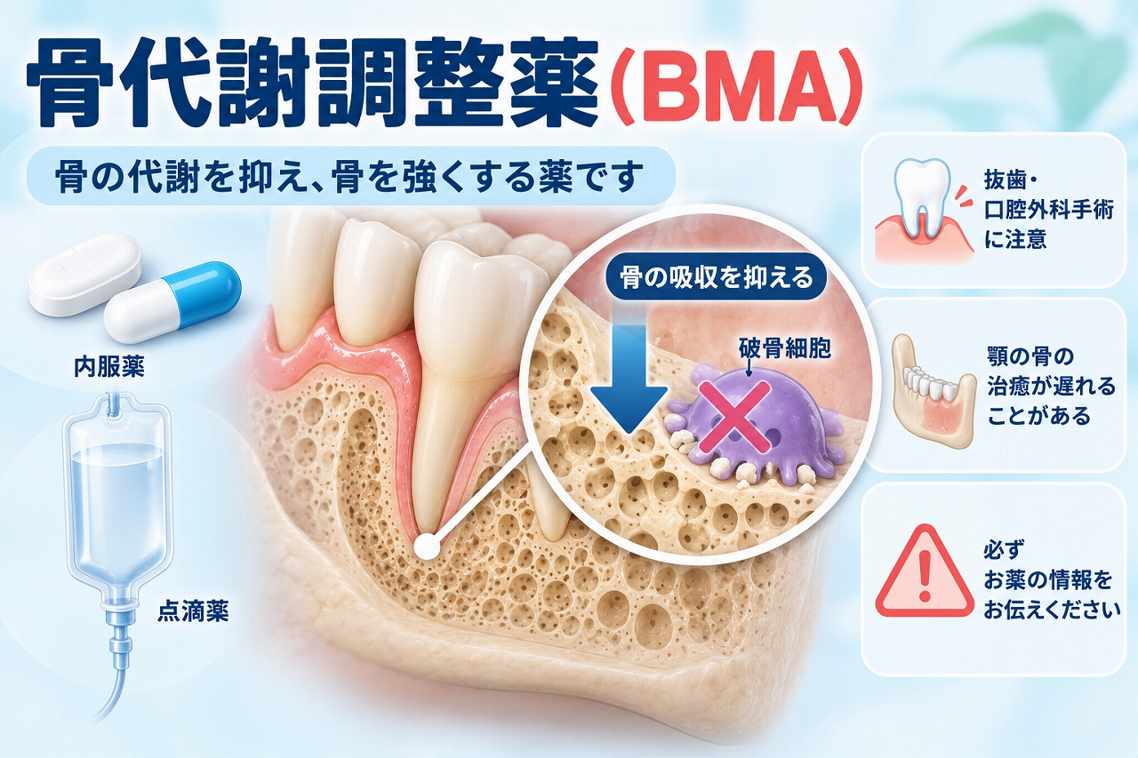 骨代謝調整薬（BMA）の内服薬・注射薬と骨吸収を抑える作用、抜歯や口腔外科治療で注意が必要なことを示した歯科イラスト