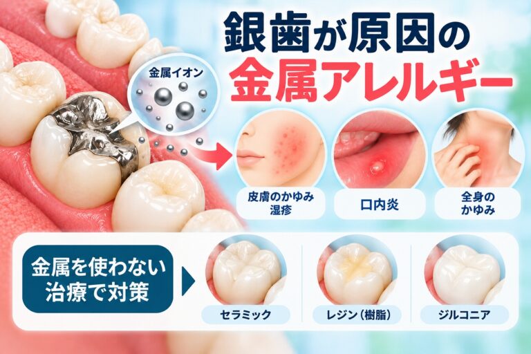 銀歯が原因の金属アレルギー｜症状とメタルフリー治療