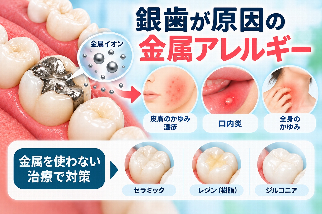 銀歯から溶け出した金属イオンによる金属アレルギーと、皮膚や口腔内の症状、セラミック・レジン・ジルコニアによるメタルフリー治療を示したイラスト