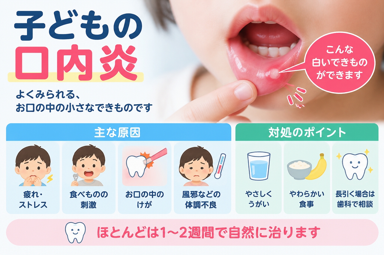 子どもの口内炎にみられる白いできものと、疲れ・食べ物の刺激・口の中のけが・体調不良などの原因や対処法を示したイラスト
