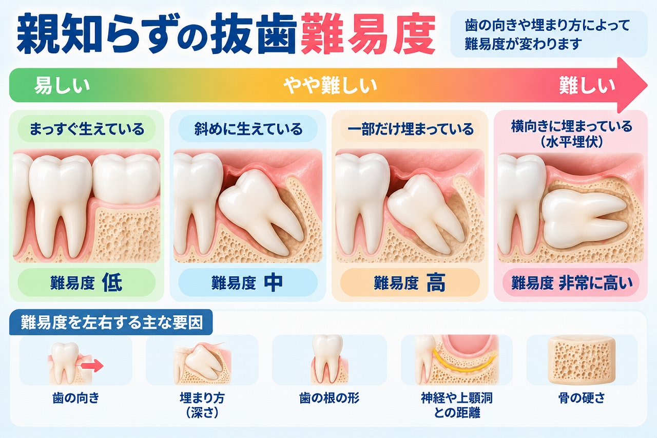 親知らずの生え方による抜歯難易度を正常・斜め・横向き・埋伏の4つの状態で比較したイラスト