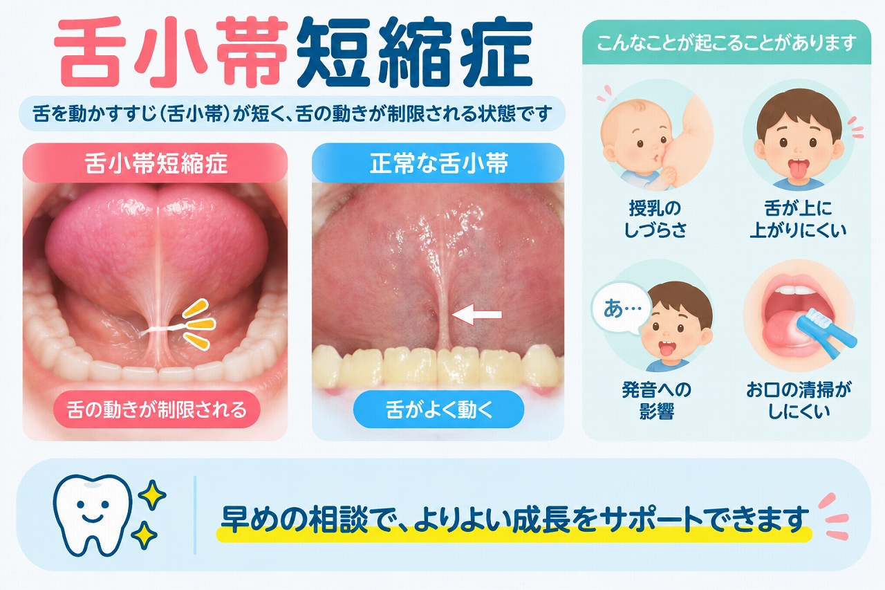 舌小帯短縮症と正常な舌小帯を比較し、舌小帯が短いことで舌の動きが制限され、授乳や発音などに影響する場合があることを示した歯科イラスト