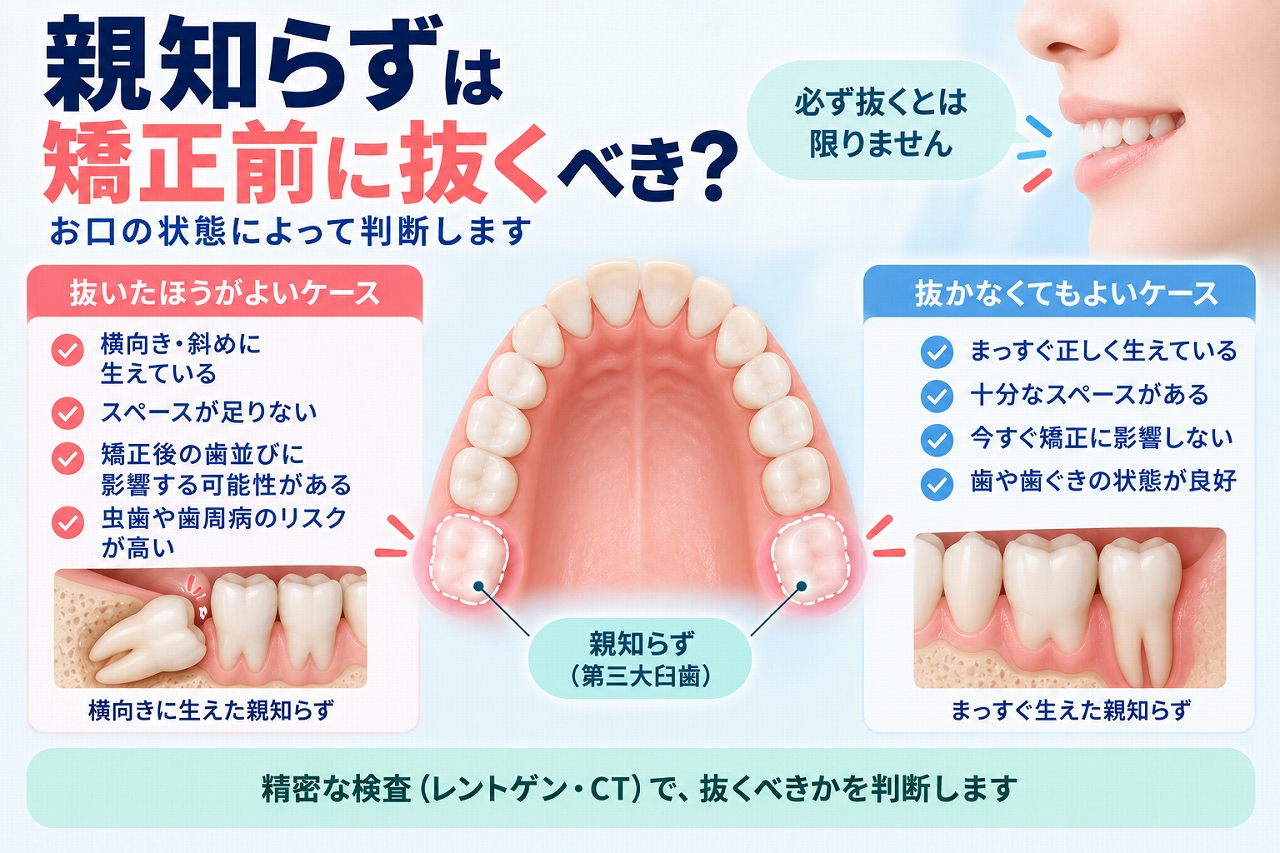 矯正前の親知らずについて、横向きや斜めに生えた抜歯を検討するケースと、まっすぐ生えて抜歯しないケースを比較した歯科イラスト