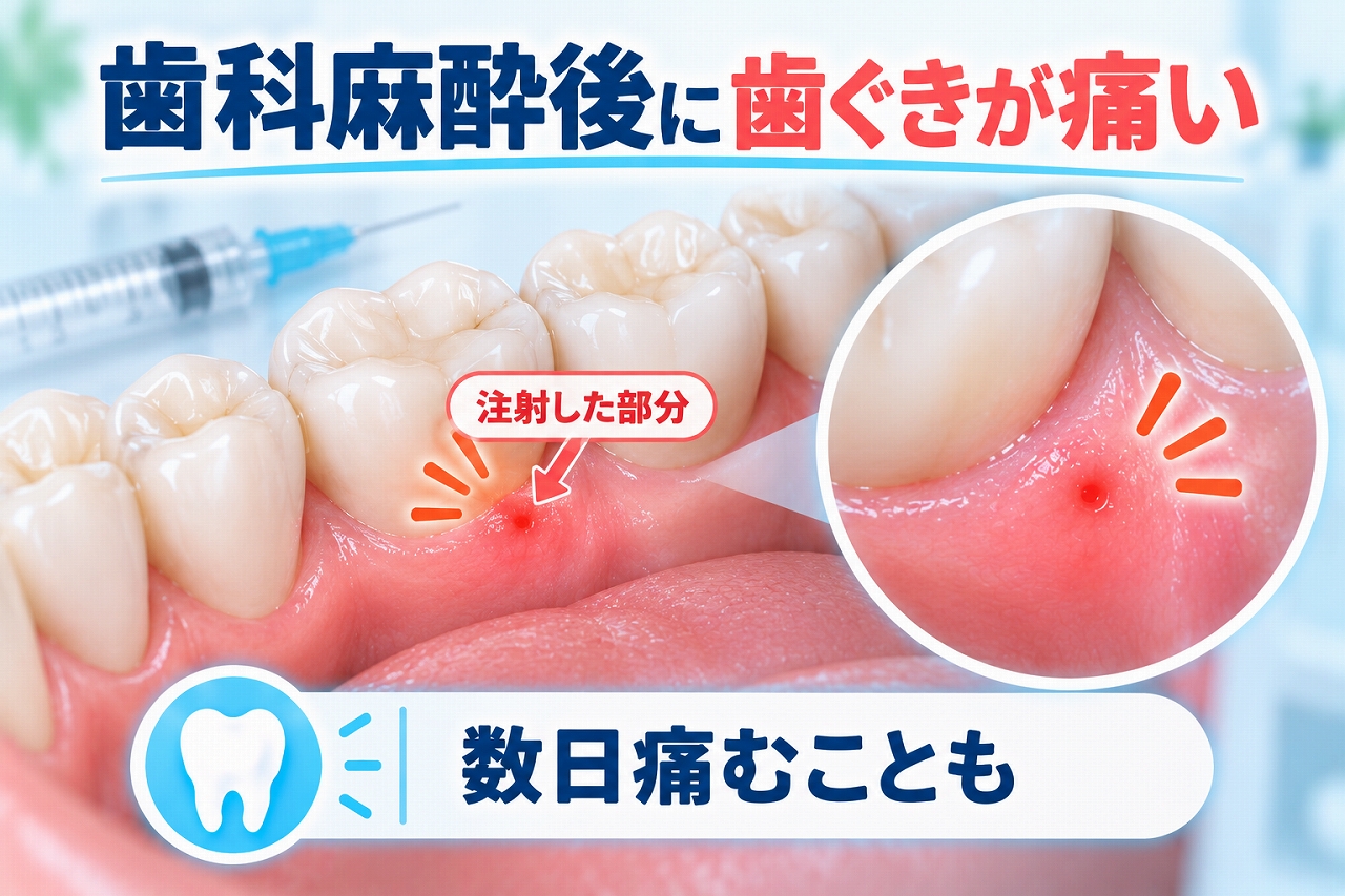 歯科麻酔後に注射した歯ぐきの部分が赤くなり、局所的な痛みが残っている状態を示したイラスト