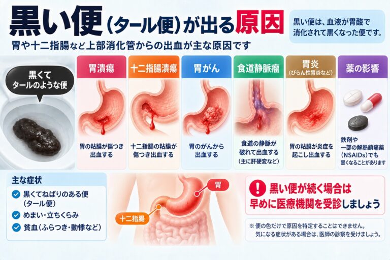 黒い便（タール便）が出る原因として、胃潰瘍・十二指腸潰瘍・胃がん・食道静脈瘤・胃炎などの上部消化管出血や、鉄剤など薬の影響を示した図