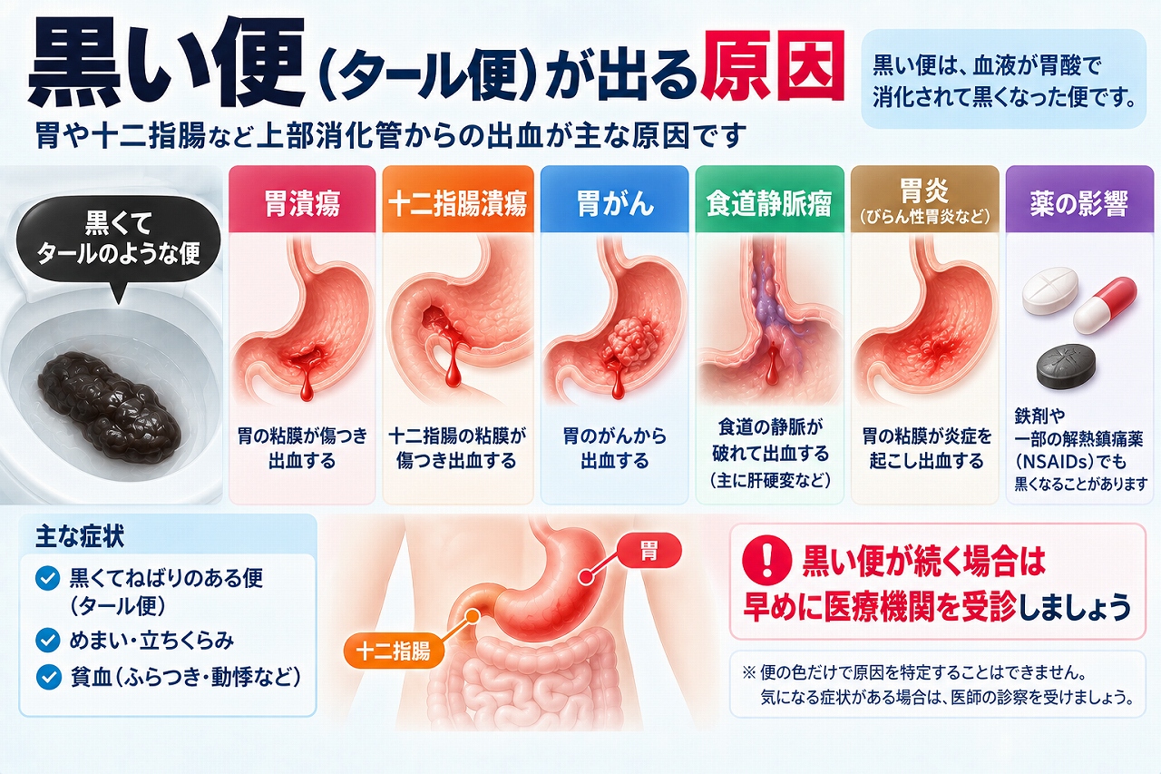 黒い便（タール便）が出る原因として、胃潰瘍・十二指腸潰瘍・胃がん・食道静脈瘤・胃炎などの上部消化管出血や、鉄剤など薬の影響を示した図