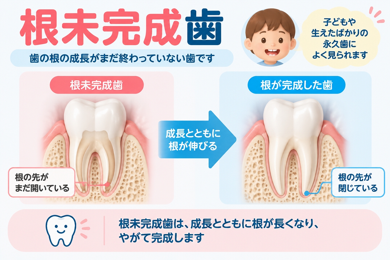 根未完成歯と根が完成した永久歯を比較し、生えたばかりの永久歯では歯根が短く根の先が開いており、成長とともに歯根が伸びて完成する様子を示した歯科イラスト