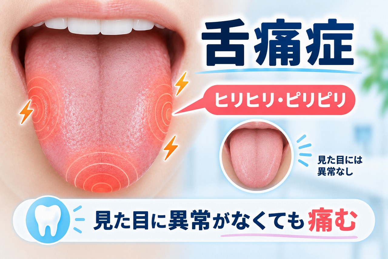 舌痛症による舌のヒリヒリ・ピリピリした痛みと、見た目には異常がない状態を示したイラスト